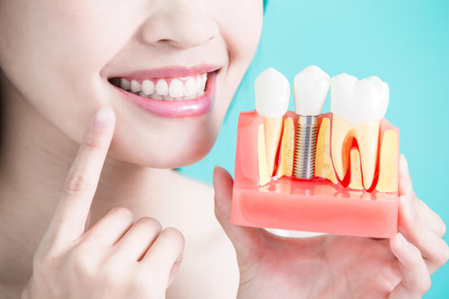 Stem Cell Dental Implants