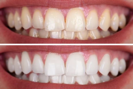 Whitening