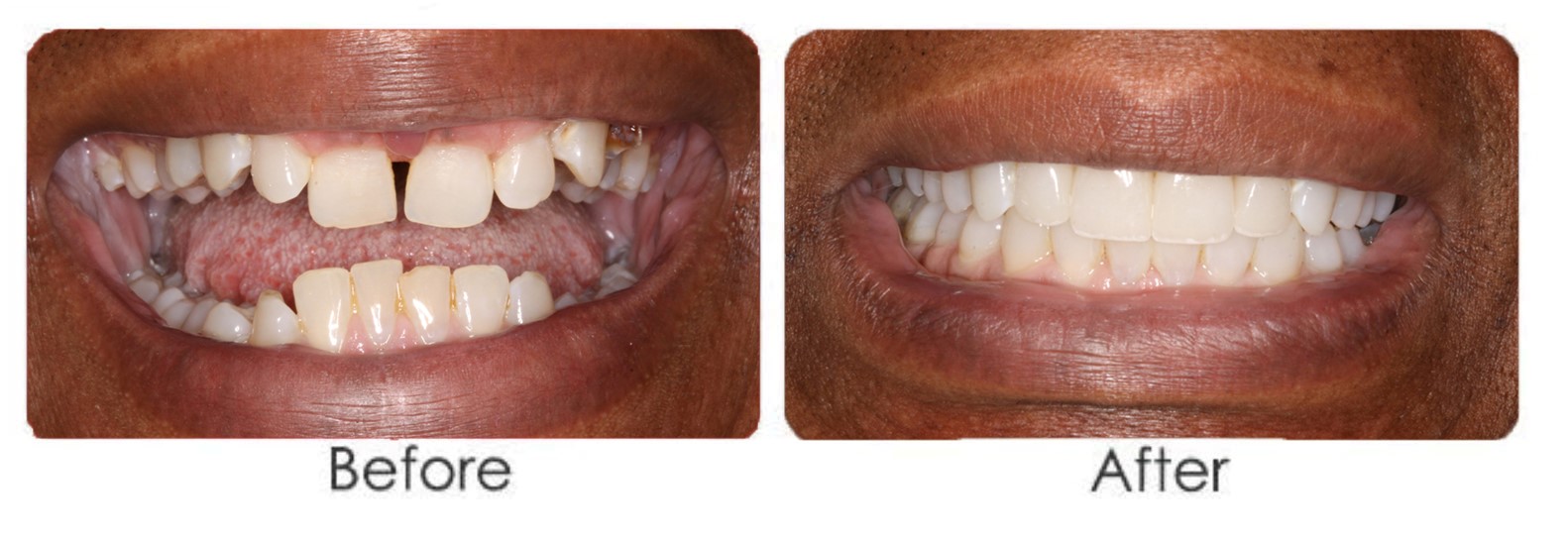 Orthodontics - Invisalign Before & After - Orthodontic therapy Ismile